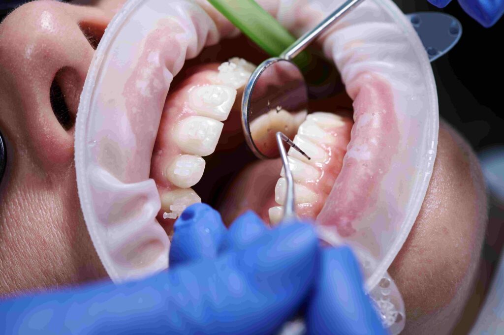 dentist in sterile gloves examining woman 
 teeth